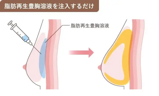 医療法人ザ・クリニックビューティー_成長因子を含んだ溶液でご自身の胸の脂肪を増殖させます